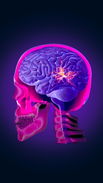 Neurotip 1
